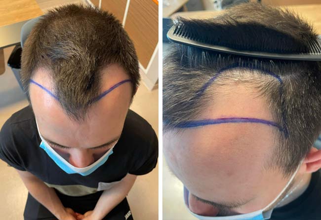 Imagen del antes del trasplante capilar FUE Zafiro de 2700 grafts del paciente Thorsten S.