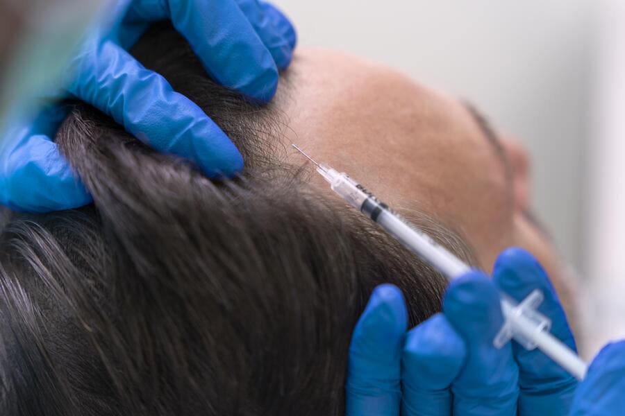 Hombre sometiéndose a un tratamiento de mesoterapia como alternativa al injerto capilar.