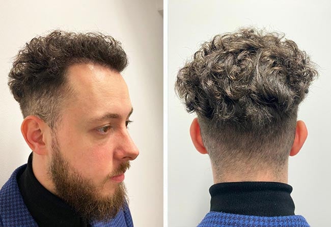 Después de 18 semanas de trasplante de cabello DHI con 3140 injertos del paciente Cilian W.