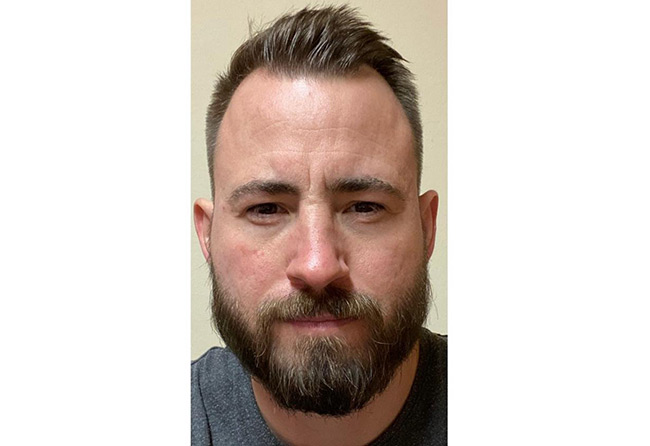 Resultado del implante de barba con el método zafiro de 4200 injertos de Steven A.