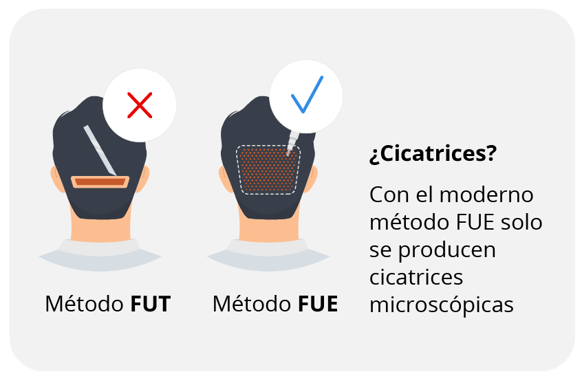 Riesgos de los injertos capilares: cicatrices.