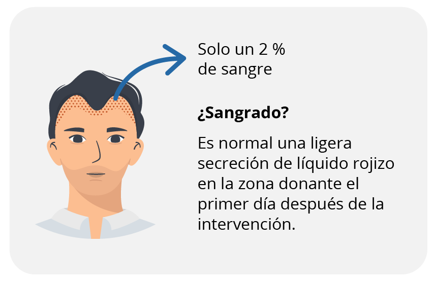 Riesgos de los injertos capilares: sangrado.