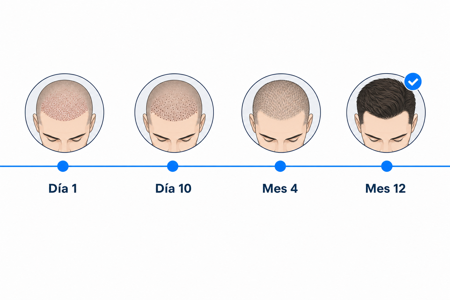 Proceso de curación tras un injerto capilar sin rasurar, del día 1 al mes 12