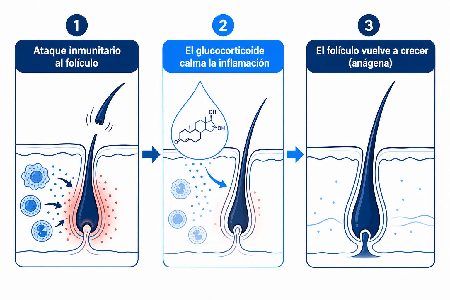 Infografía: cómo los glucocorticoides calman el ataque inmunitario al folículo piloso y permiten que el cabello vuelva a crecer