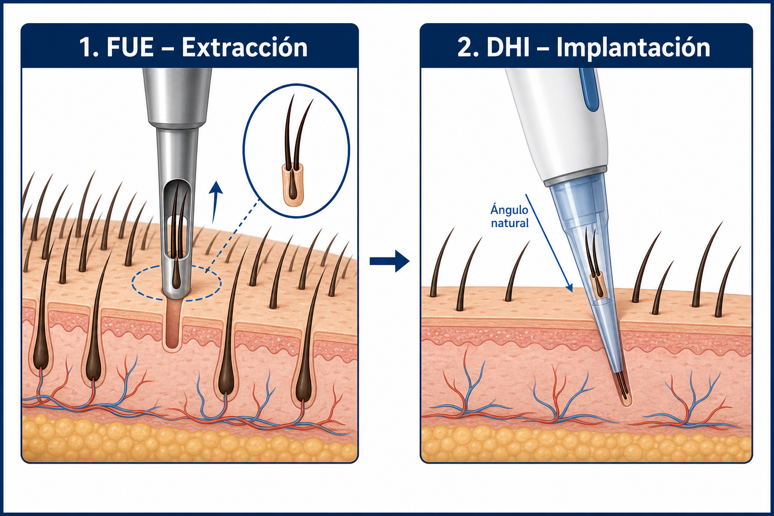 Proceso de un injerto capilar: extracción FUE de los injertos a la izquierda, implantación DHI con lápiz CHOI a la derecha
