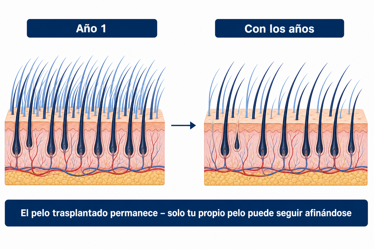 El pelo trasplantado permanece de forma permanente; solo el pelo propio que queda entre medias puede seguir aclarándose con los años
