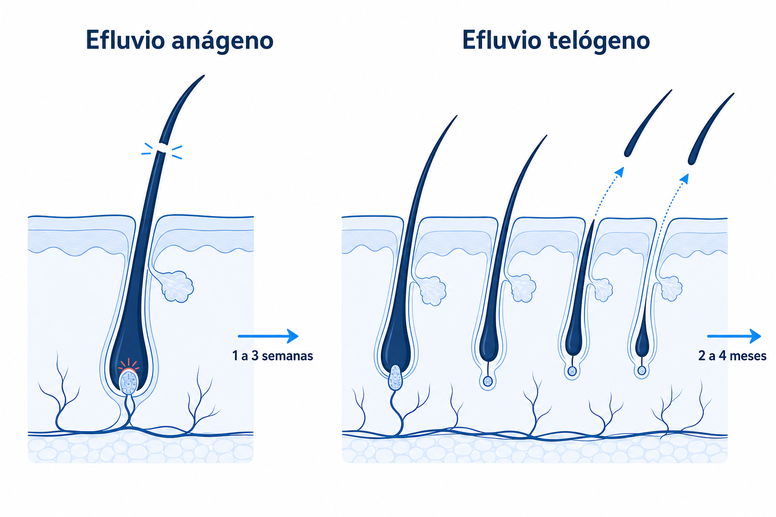 Comparación entre efluvio anágeno y telógeno: rotura del cabello en la fase de crecimiento a las 1 a 3 semanas frente a caída difusa en la fase de reposo a los 2 a 4 meses