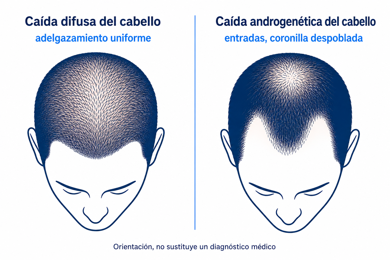 Diagrama comparativo de caída difusa frente a androgenética del cabello, dos siluetas de cabeza con patrón de adelgazamiento