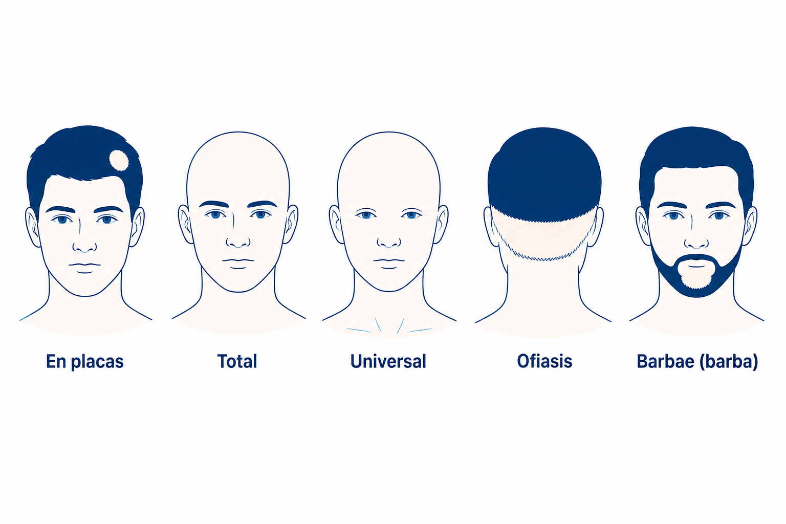 Formas de la alopecia areata: en placas, total, universal, ofiasis y barbae