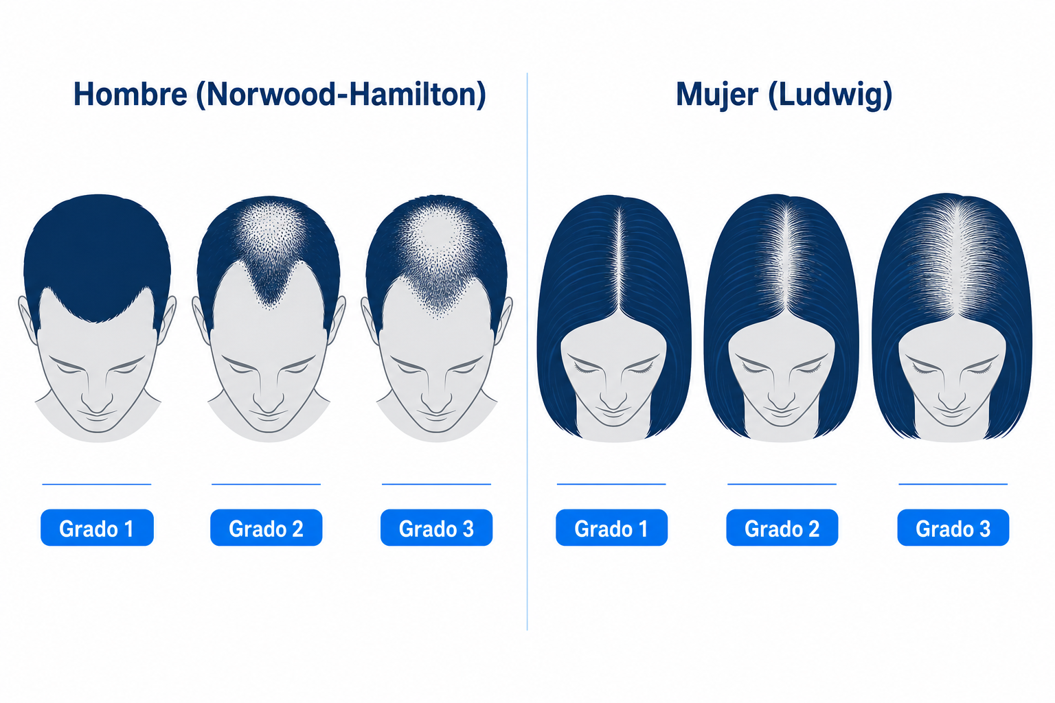 Comparación esquemática de los patrones de caída del cabello en el hombre (Norwood-Hamilton) y en la mujer (Ludwig) en la alopecia androgenética