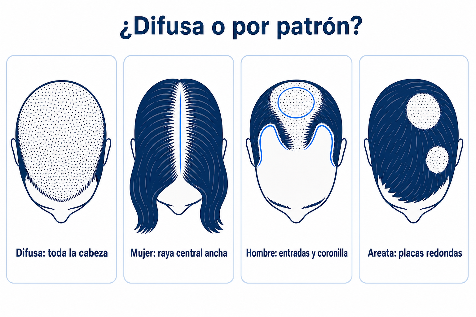 Comparación de cuatro patrones de caída del pelo: pérdida difusa de densidad en toda la cabeza, raya central ancha en la mujer, entradas y coronilla en el hombre, placas redondas sin pelo en la alopecia areata