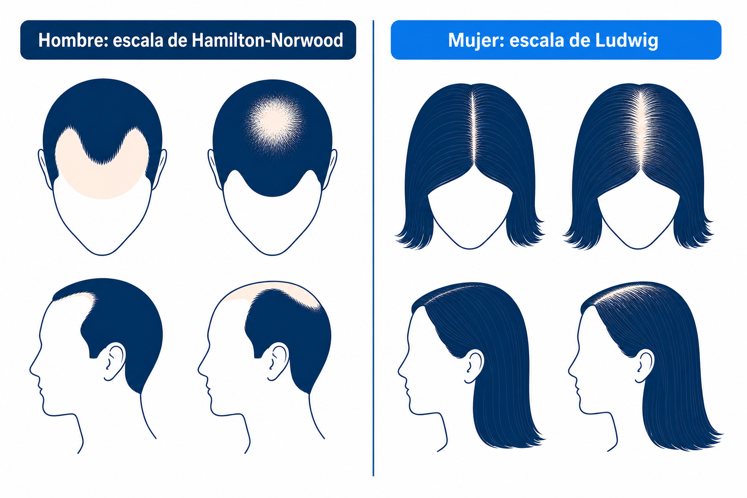 Comparación de los patrones de alopecia androgenética en el hombre (escala de Hamilton-Norwood) y en la mujer (escala de Ludwig), uno junto al otro