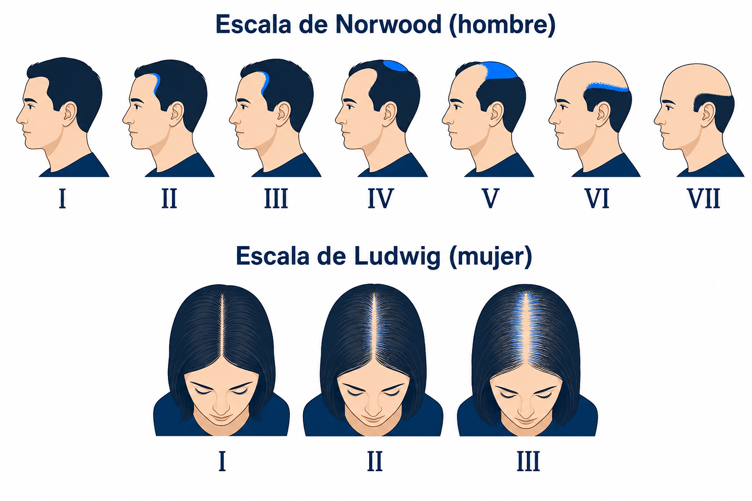 Escala de Norwood para hombres y escala de Ludwig para mujeres para clasificar la alopecia de patrón