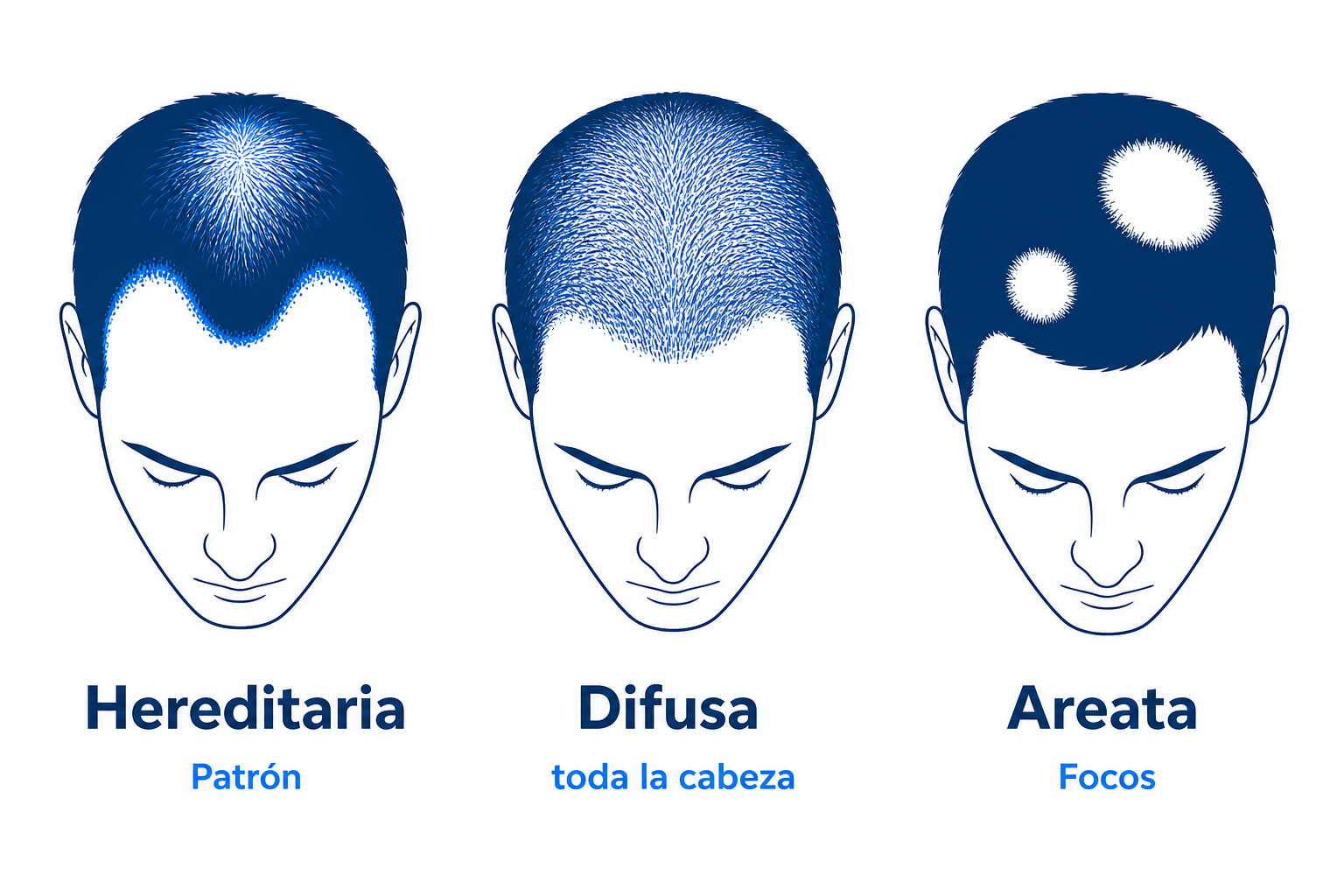 Infografía de los tres tipos de caída del cabello: hereditaria, difusa y areata