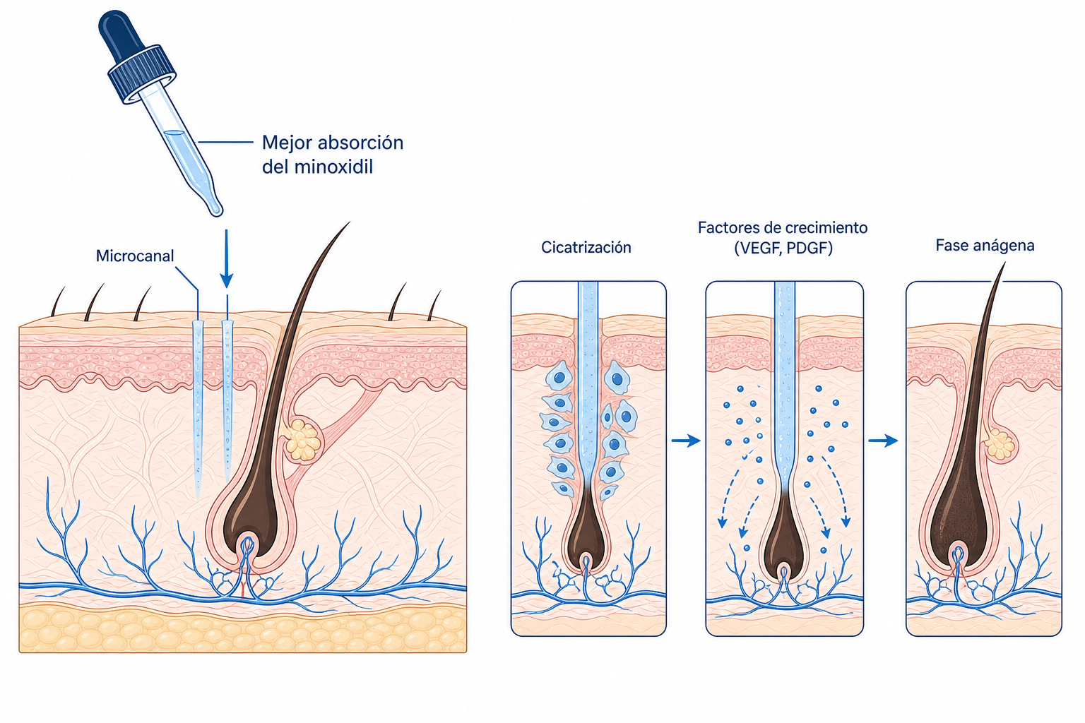Ilustración del mecanismo de acción del microneedling en el cuero cabelludo: microcanal, cicatrización, factores de crecimiento y fase anágena