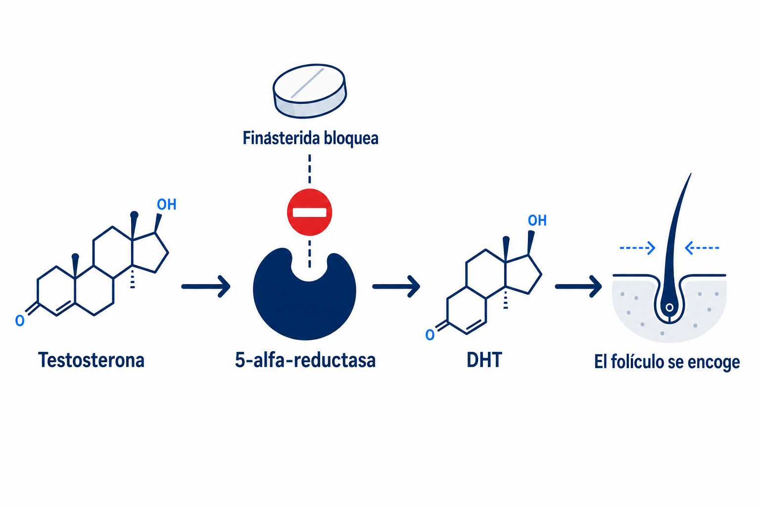 Diagrama del mecanismo de acción de la finasterida: la finasterida bloquea la 5-alfa-reductasa y reduce el DHT