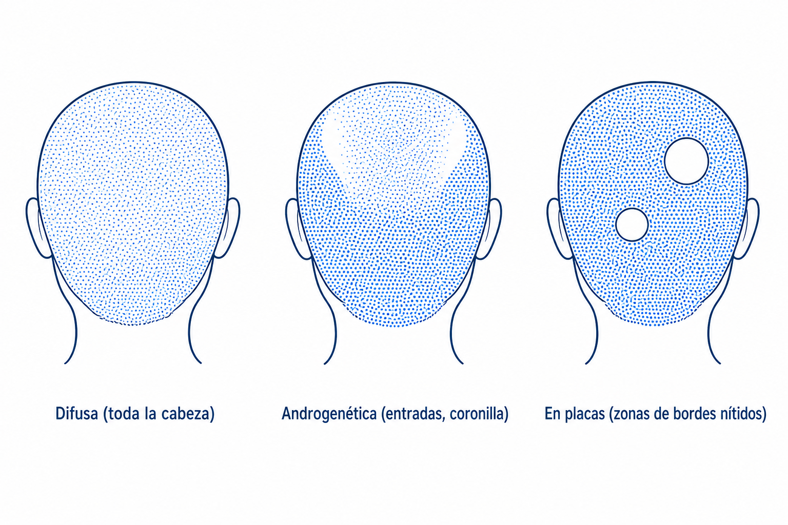 Comparación de los tres patrones de caída: difuso, androgenético y en placas, como siluetas de cabeza