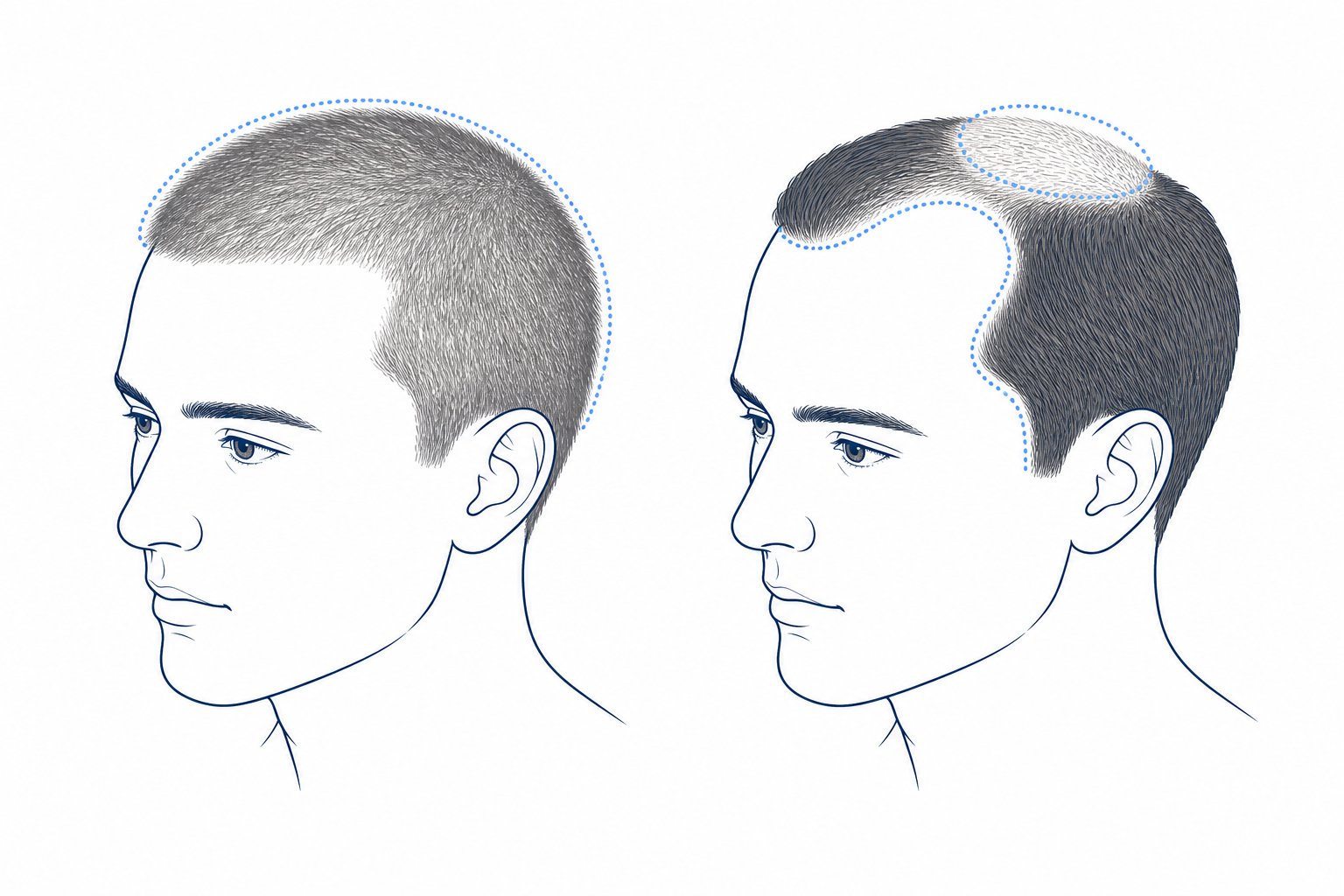 Ilustración comparativa: a la izquierda, un cabello afinado de forma difusa y uniforme; a la derecha, el patrón de la caída hereditaria en las entradas y la coronilla