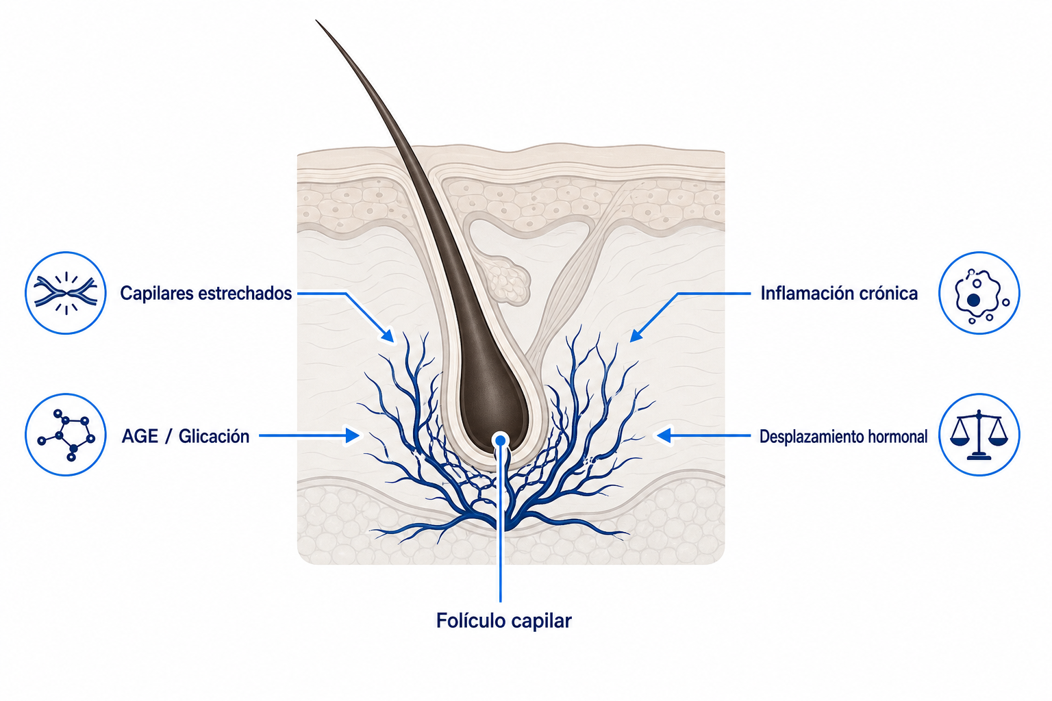 Ilustración de un folículo capilar en un corte de la piel con los cuatro mecanismos por los que la diabetes altera el crecimiento del cabello