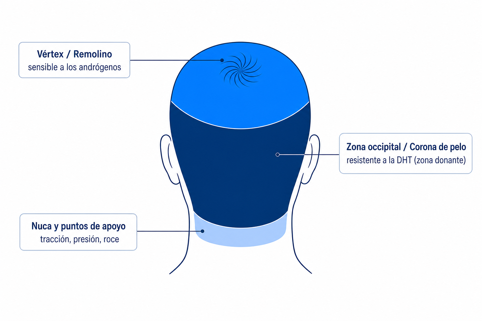 Zonas de la parte posterior de la cabeza: vértex con remolino, zona donante occipital y nuca con sus causas típicas