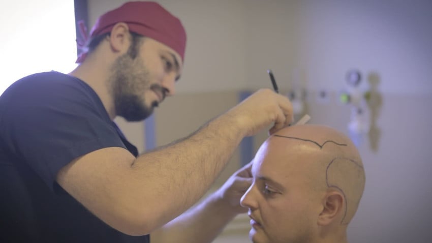 est-il possible de faire des implant capillaire avec une calvitie totale