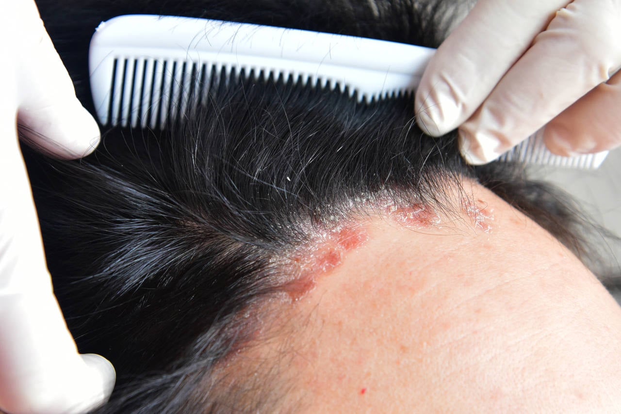le psoriasis des cheveux est une maladie courante du cuir chevelu