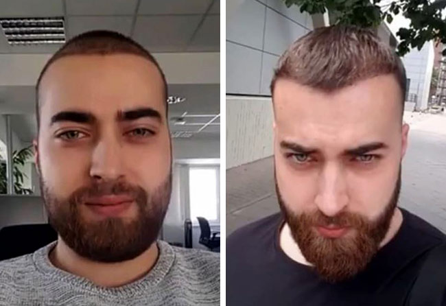 Image apres implant de barbe saphir 4250 greffons Andre Ulbrich