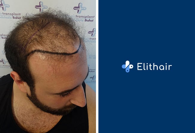 avant-greffe-de-cheveux-fue-saphir-3500-greffons-artin-a-elithair