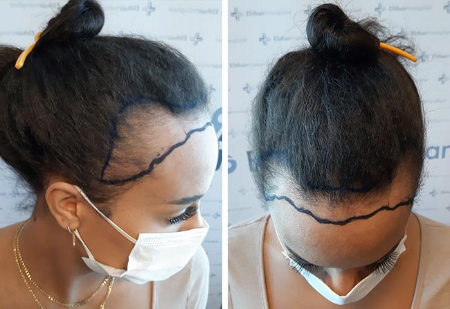 Image avant greffe de cheveux femme SDHI 3200 greffons Jahy C