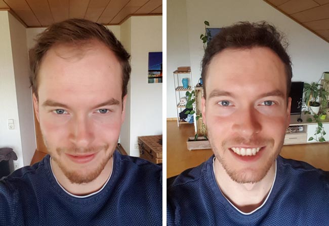 Image avant après greffe de cheveux DHI 3500 greffons Lukas jaeger