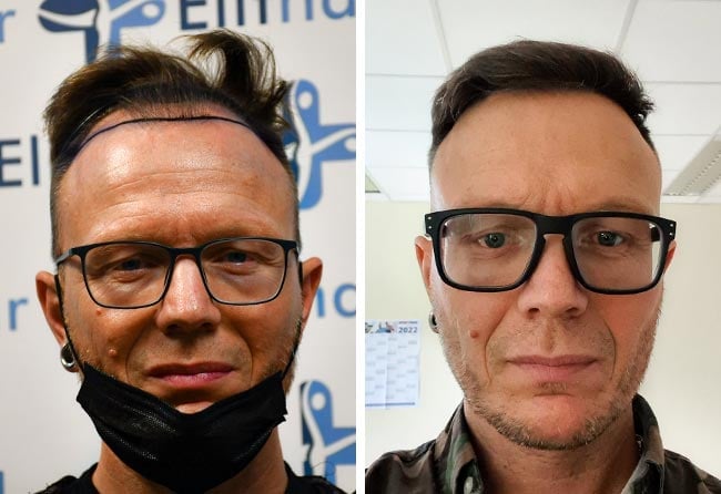 Image avant après greffe de cheveux DHI 4500 greffons Steffen Kraeuter