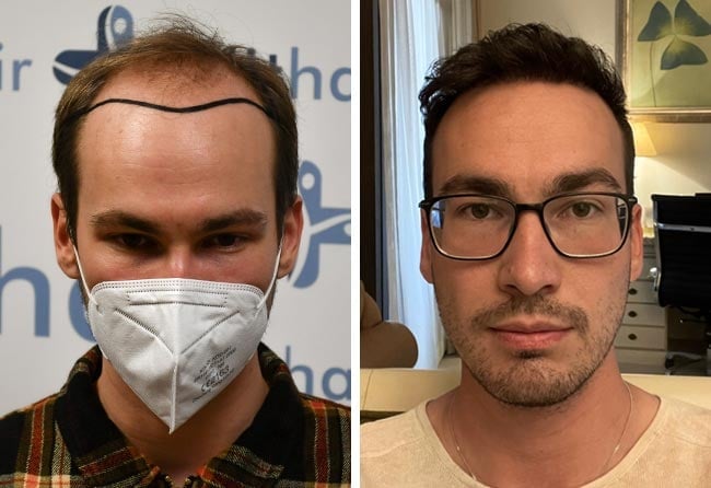 Image avant après greffe de cheveux DHI 4700 greffons Marcel Ploch