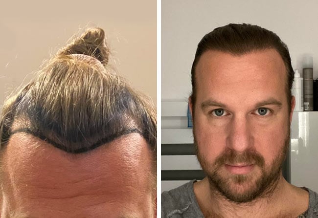 Image avant après greffe de cheveux SDHI 2700 greffons Matthias Funk