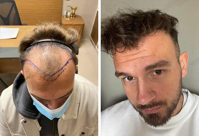 Image avant après greffe de cheveux saphir 4500 greffons Sefket Ahmetovic