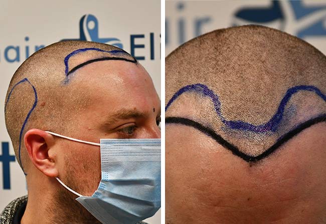 Image avant greffe de cheveux dhi 2000 greffons Achim Klein