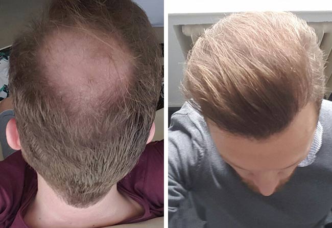Photo avant apres greffe de cheveux saphir 3700 greffons Stefan Heckmann