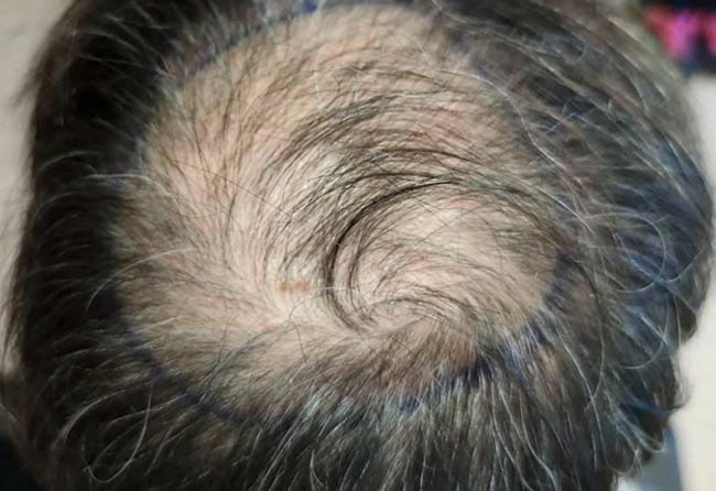 Photo avant greffe de cheveux saphir 3100 greffons Tonsure Dani El