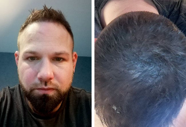 Photo résultat greffe de cheveux saphir 4700 greffons patrick bertram