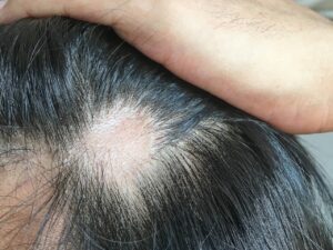Image d'une cicatrice sur un cuir chevelu a causé une plaque de calvitie visible