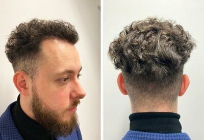Photo prise 4 mois et demi après la greffe de cheveux dhi avec 3140 greffons du patient Cilian White