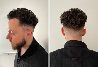 Photo prise 6 mois après la greffe de cheveux dhi avec 3140 greffons du patient Cilian White