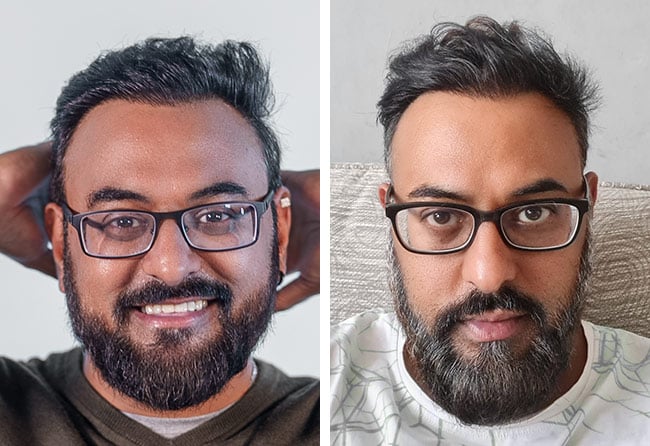 Résultat greffe de cheveux DHI 4000 greffons Shahid A.