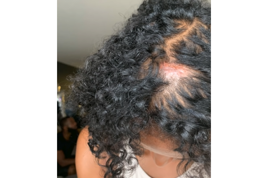 alopécie après des tresses afro avec des mèches sythétiques