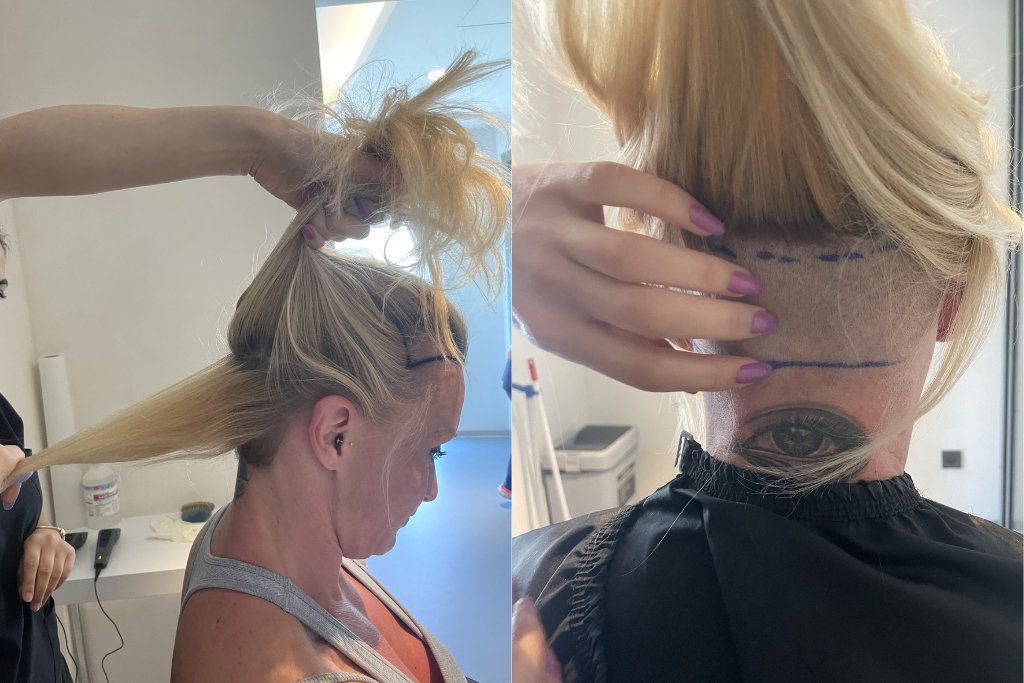 Exemple d'un rasage partiel d'une greffe de cheveux femme avec la clinique du cheveu Elithair