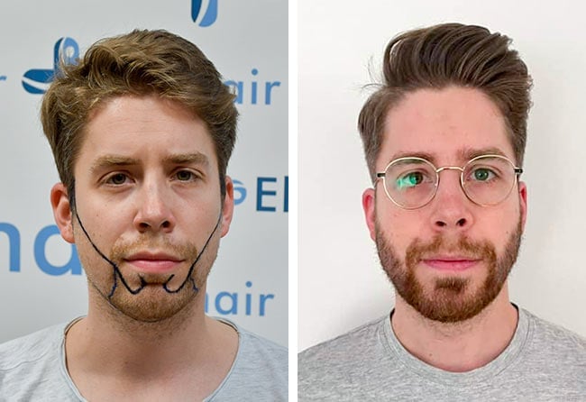 Patient Eike R avant après greffe de barbe saphir