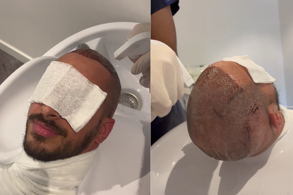 comment laver à l'eau ses cheveux après une greffe ? Elithair