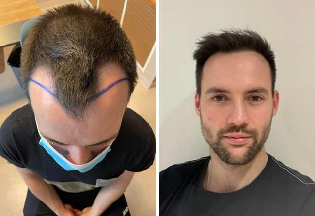 Image avant après greffe de cheveux saphir 2700 greffons Thorsten S.