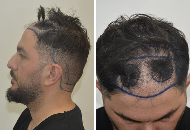 Photo avant greffe de cheveux DHI 4200 greffons Onur Y.