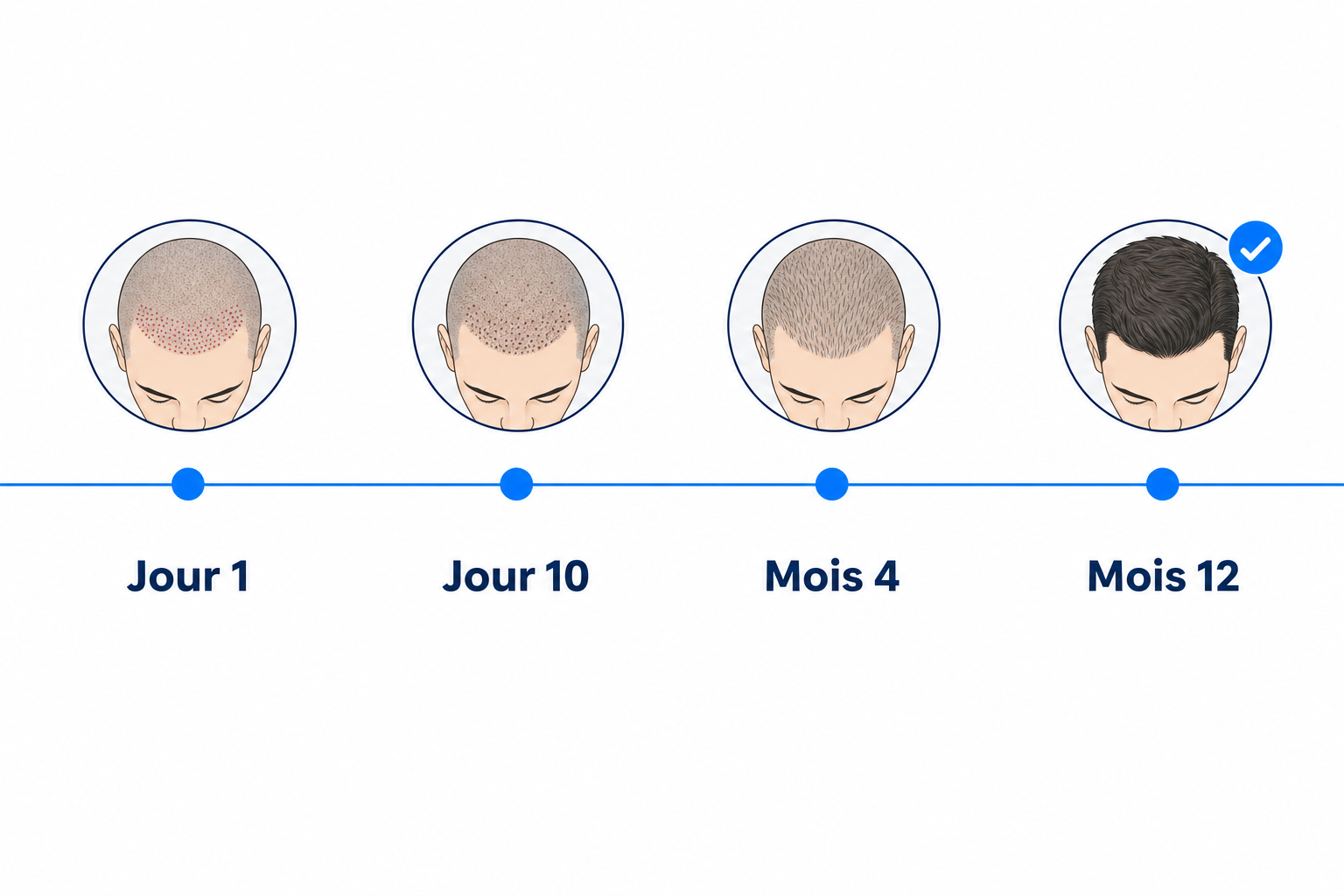Évolution de la cicatrisation après une greffe de cheveux sans rasage, du jour 1 au douzième mois
