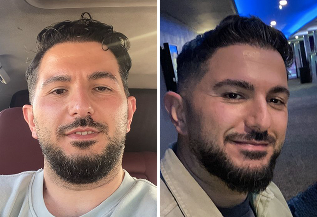 Photo résultat après greffe de cheveux DHI 4200 greffons Onur Y.